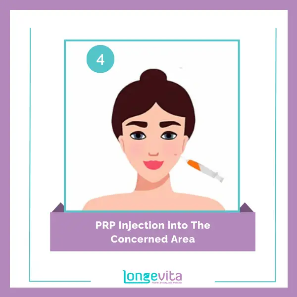 PRP Injection into The Concerned Area