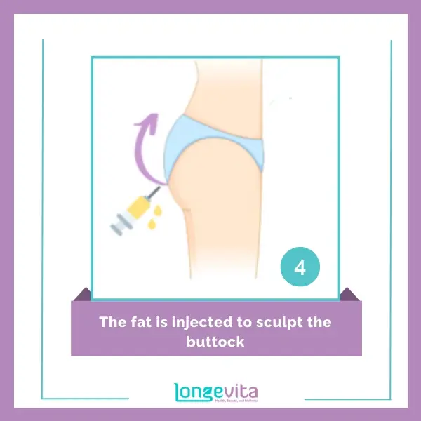 4 The fat is injected to sculpt the buttock