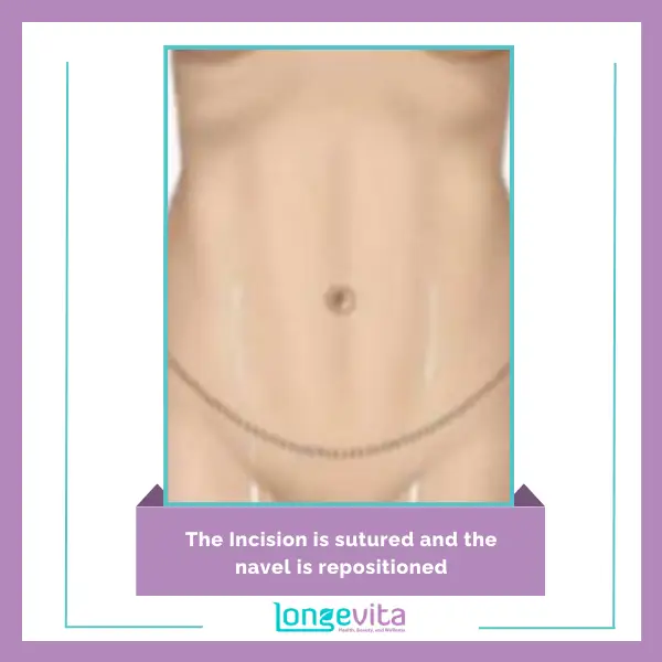 5 Tummy Tuck Incisions Sutured