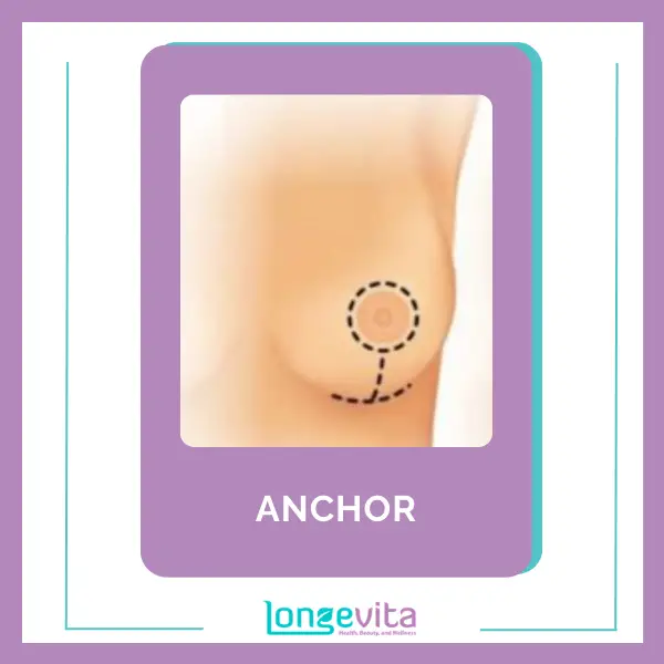 Anchor type Breast Implant Incision