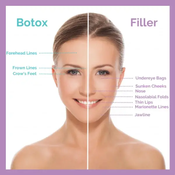 Botox x filler (1)