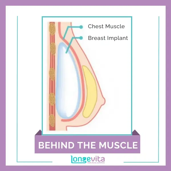 Breast Implant Placed Below the Chest Muscle