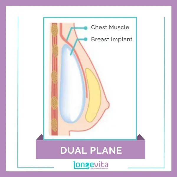 Breast Implant Put in the Dual Plane Position, Partially Beneath the Chest Muscle