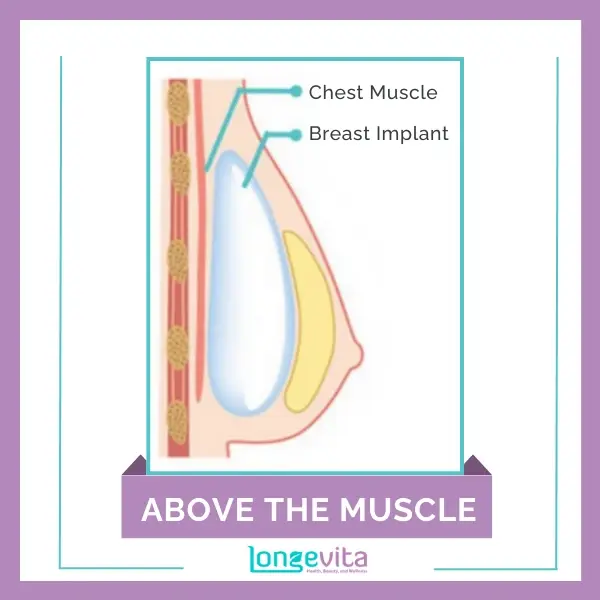 Breast implant placed above the chest muscle