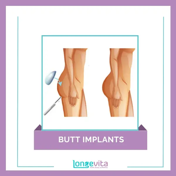 Butt Implants