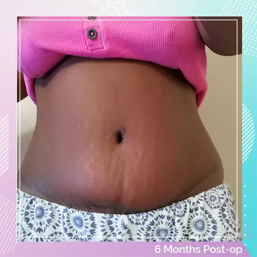 Connie Adoli Tummy Tuck After