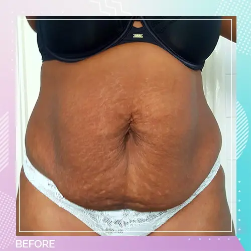 Connie Adoli Tummy Tuck Before