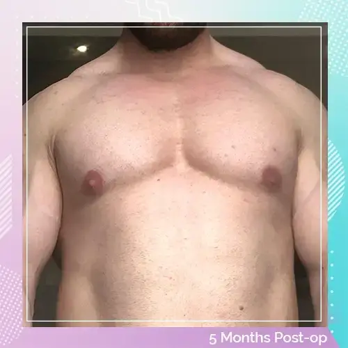 Craig Obrien after gynecomastia2