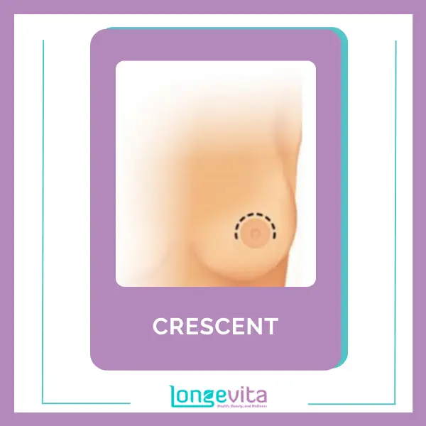 Crescent Breast Implant Incision