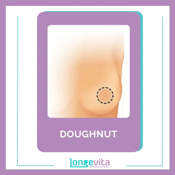 Doughnut type Breast Implant Incision