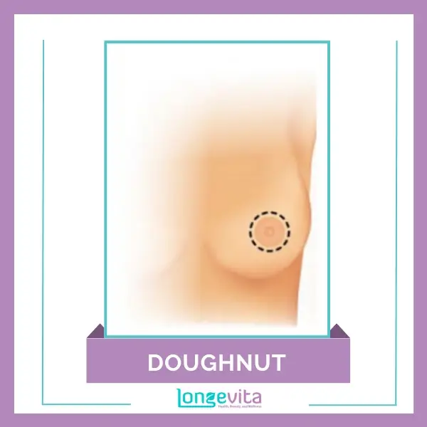 Doughnut Incision Breast Implant