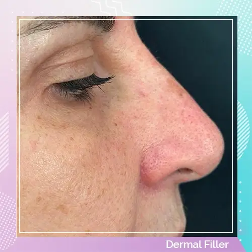 Dr Gizem non surgical nose job patient 2 after