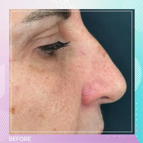 Dr Gizem non surgical nose job patient 2 before