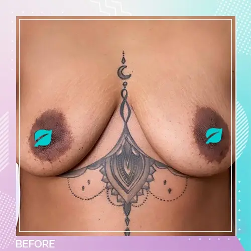 Faadumo Ali breast lift before 2