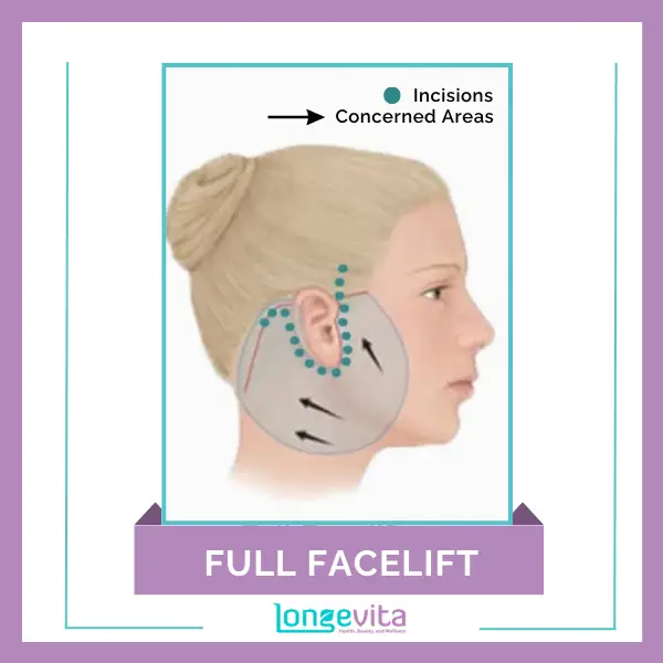 Full Facelift with incisions and concerned areas