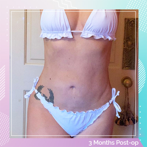 Janine Lewis Liposuction After