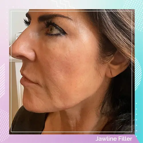 Jawline Filler Dr Gizem Patient after