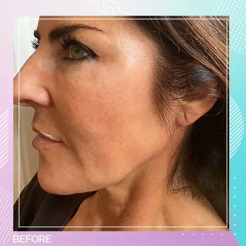 Jawline filler Dr Gizem Patient before