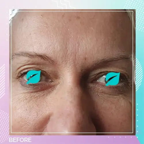 Karen Godfrey eyelid before