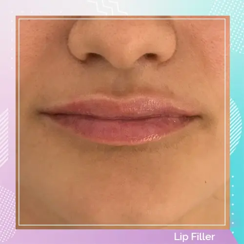 Lip Filler Dr Gizem Patient after