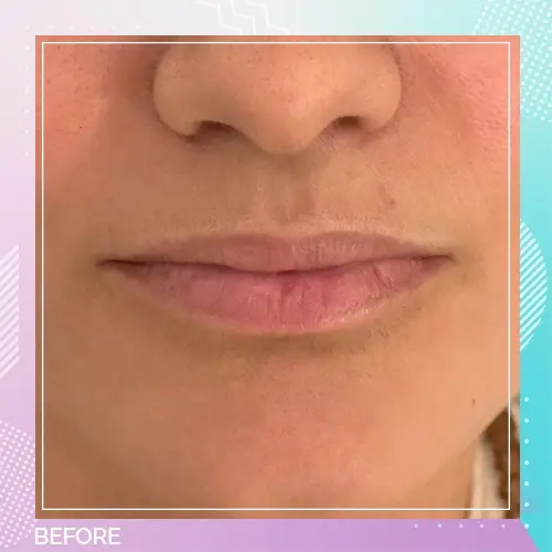 Lip Filler Dr Gizem Patient before