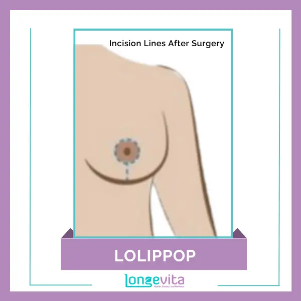 Lollipop Breast Reduction Incision Lines After Surgery