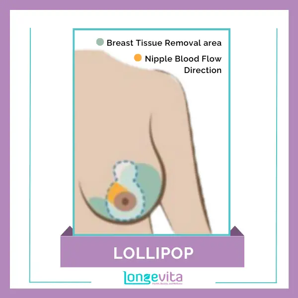 Lollipop Breast reduction with Breast Tissue Removal are and Nipple Blood Flow Direction