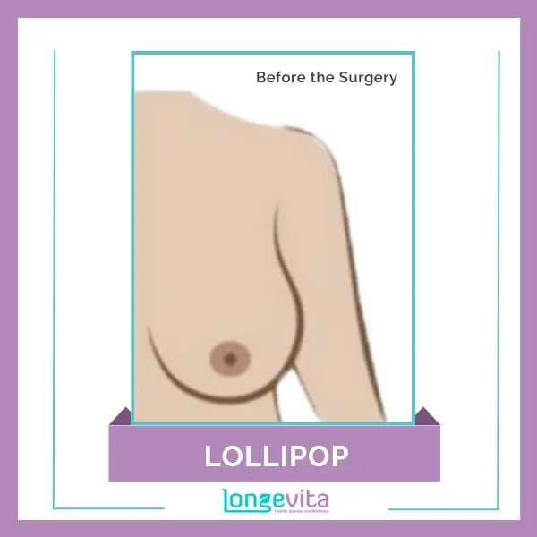 Lollipop Reduction Before the Surgery