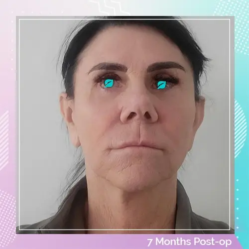 Maria Bernadette Brady Facelift After