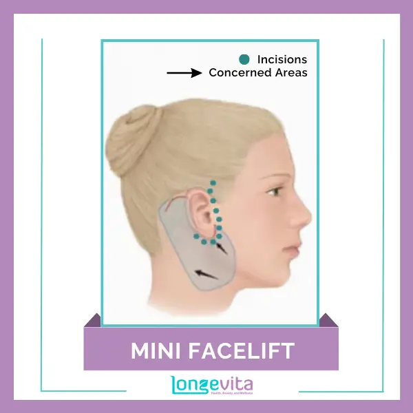 Mini facelift with incisions and concerned areas