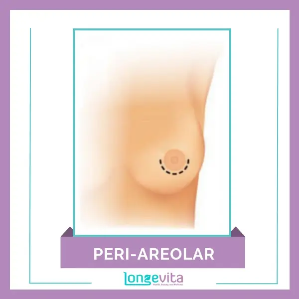 Peri Areolar Breast Implant Incision Site