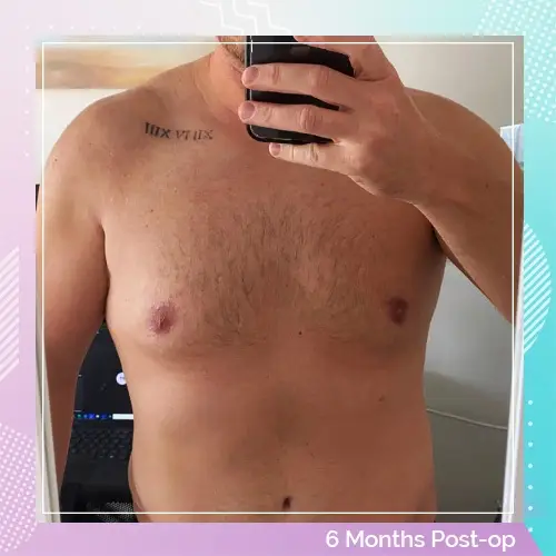 Thomas Richards gynecomastia after