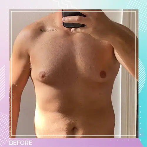 Thomas Richards gynecomastia before